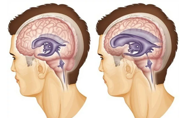 Pression intracrânienne