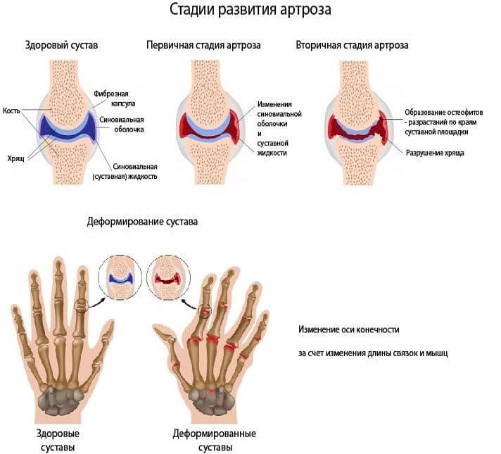Stages of arthrosis
