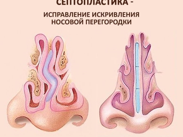 Courbure du septum nasal: vaut-il la peine et quelles complications sont possibles, traitement sans chirurgie