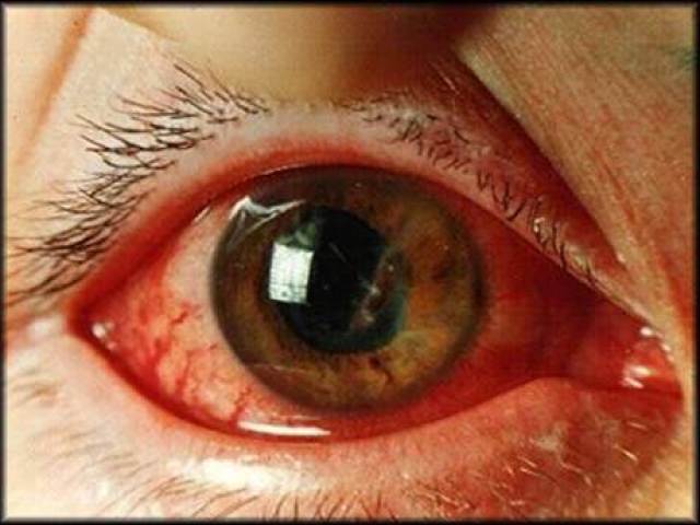 Krvavitev v očesu: vzroki in zdravljenje. Krvavitev v očesu z glavkomom in diabetesom mellitusom pri otrocih, novorojenčkih: vzroki in zdravljenju. Je nevarno, ko plovilo poči v oko?