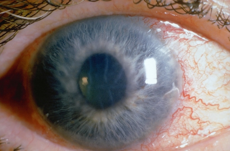 Лечение глаукомы настойкой личинок восковой моли