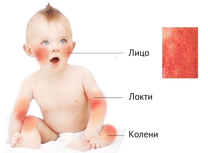 Najlepšie emolety pre atopickú dermatitídu u detí: Zoznam a mená liekov