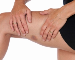 When you do massage, should there be bruises? Why do bruises appear after anti -cellulite massage and how to deal with it?