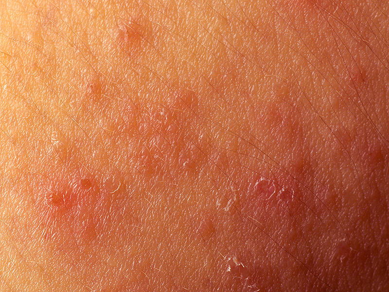 The manifestation of atypic dermatitis