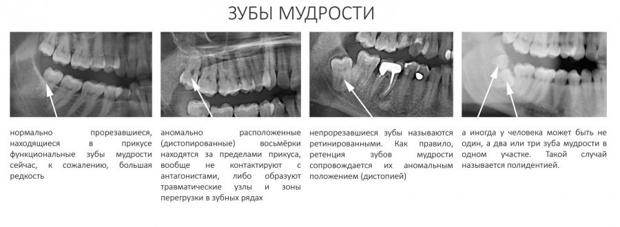 Нормално и ненормално местоположение