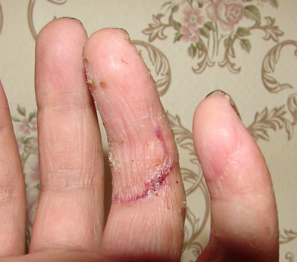 Как снимают хирургические швы с пальца руки?