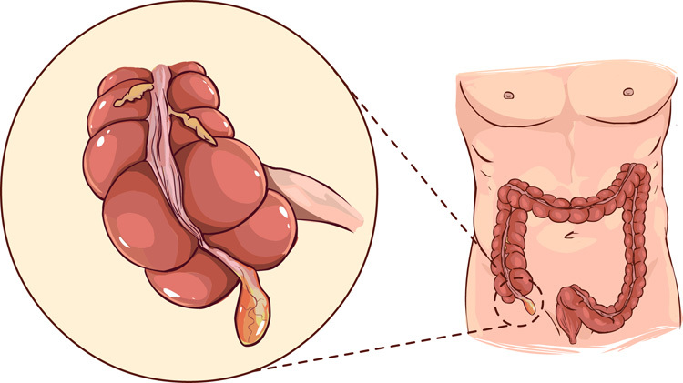 Inflammation de l'appendicite