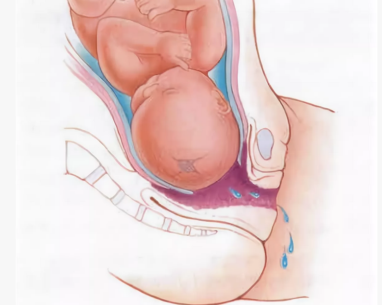 Early discharge of amniotic fluid in a woman before childbirth