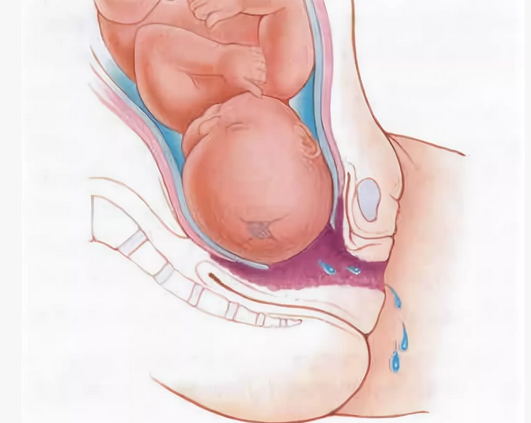 Раннее отхождение околоплодных вод у женщины перед родами