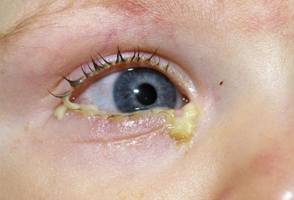 Infection bactérienne de l'œil