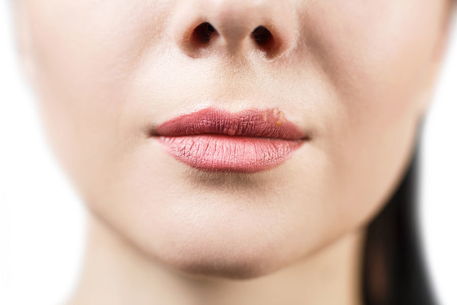 Herpes on the lips - treatment