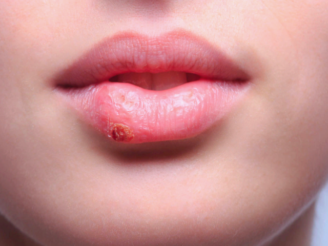 What is the cold, herpes on the lip, nose, language of the girl, women, men: omen, what does this mean?