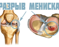Koji je meniskus zgloba koljena? Ruptura meniskusa zgloba koljena: uzroci, simptomi, liječenje