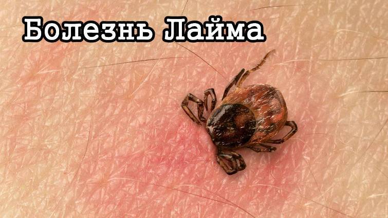 Penyakit Lyme