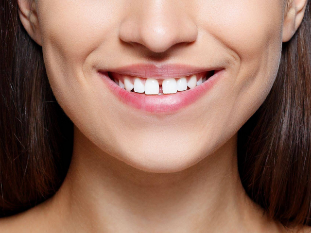 Az első fogak közötti rés: pozitív jelek, negatív érték