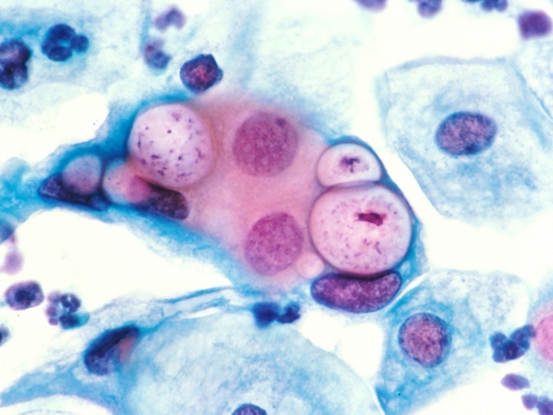 Chlamydia-fertőzés