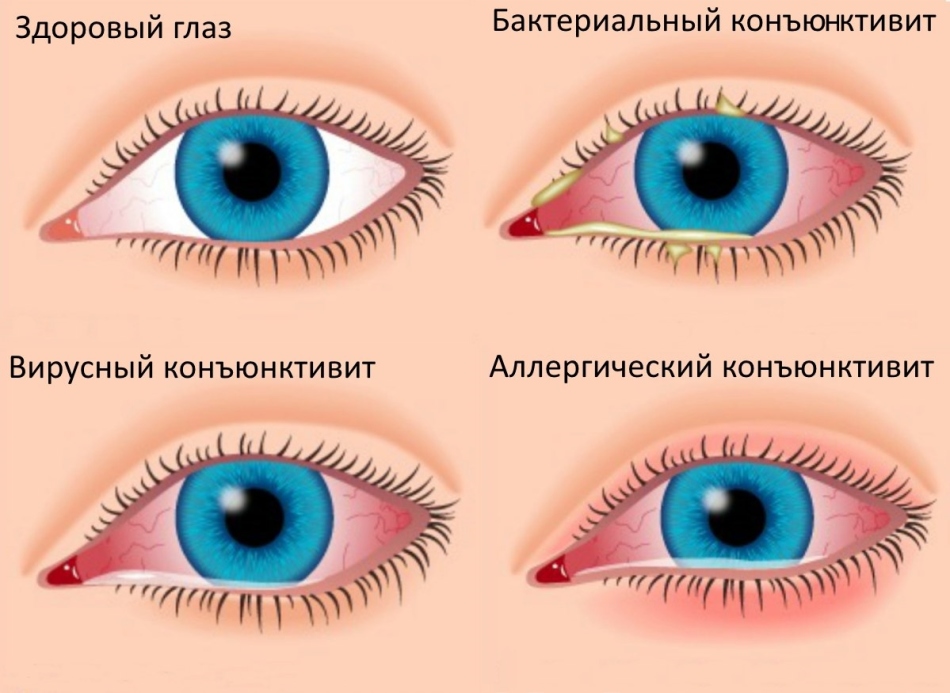 Jenis-Konjunctivitis