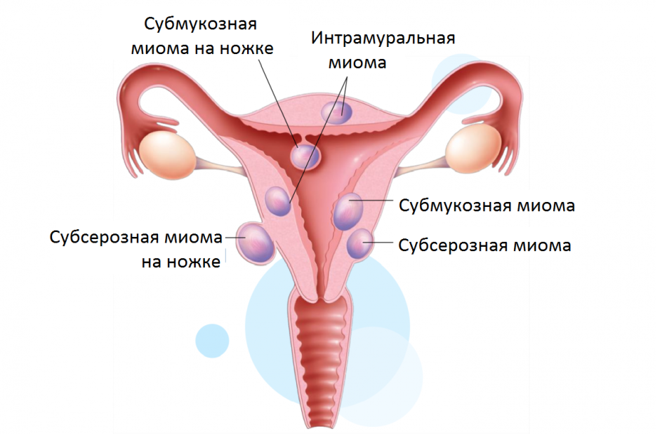 La probabilité de grossesse avec des fibromes utérins de la subsserose