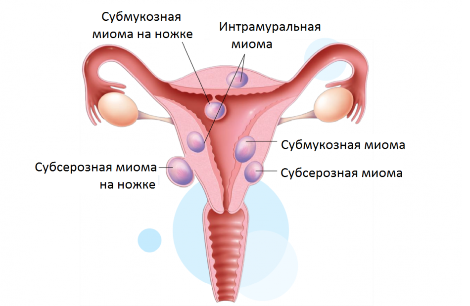 ความน่าจะเป็นของการตั้งครรภ์ด้วยการย่อยของมดลูก fibroids