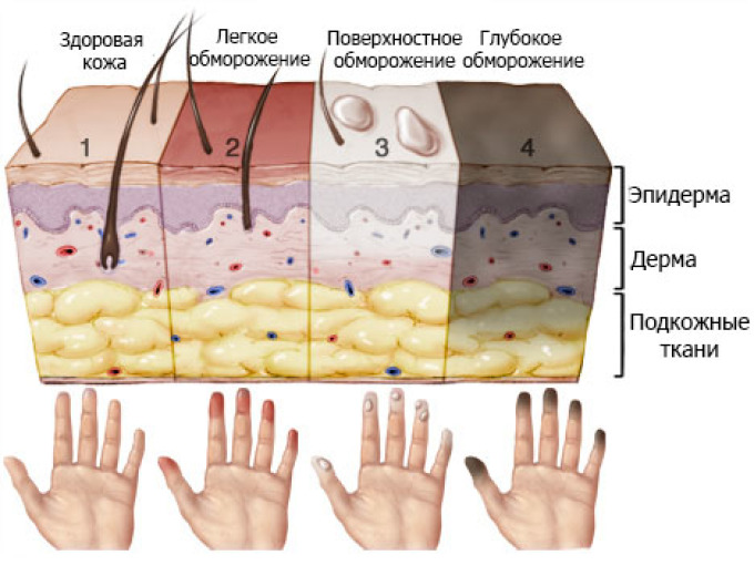 Skin lesion during frostbite of varying severity.