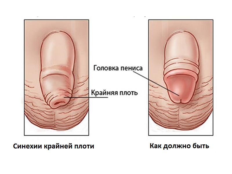 Пенис при заболевании и как должно быть