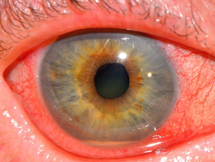 Глаукома и кровоизлияние