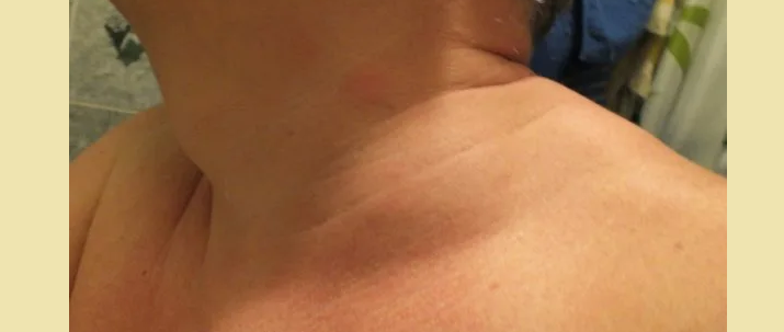 Swelling on the neck, the neck is swollen on the left side above the collarbone
