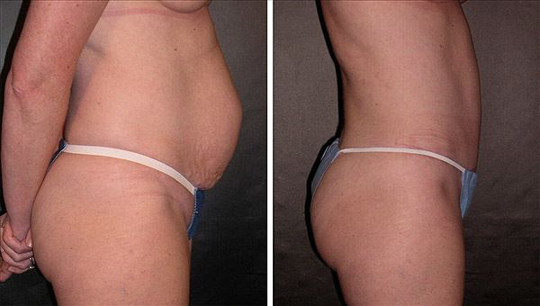 Laser lipolysis of the abdomen, photo before and after