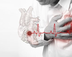 A miokardiális infarktus első jelei a nőkben és a férfiakban, és elsősegély: Leírás. A közeledő miokardiális infarktus jelei a 30, 40, 50 évesnél fiatalabb nőkben és férfiakban, fiatalok és időskorúak