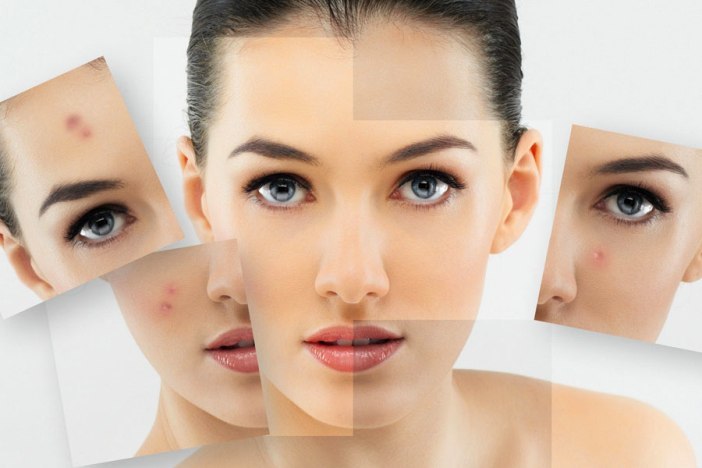 La qualité élevée et les moyens efficaces aident l'acné sur le visage