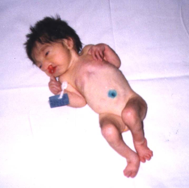 Σύνδρομο Patau σε παιδιά: Φωτογραφίες νεογέννητων