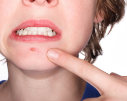 Pourquoi l'acné saute au même endroit: raisons, signes, traitement, prévention