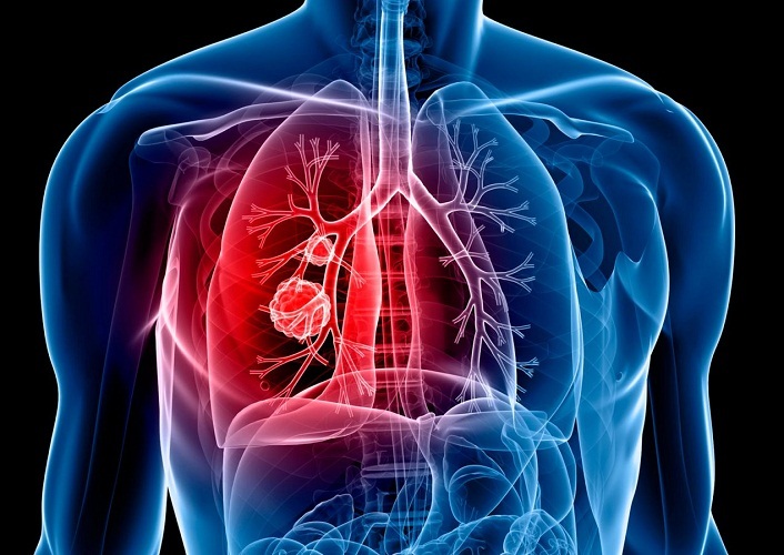 Lung cancer is dangerous because it is practically not expressed in the early stages