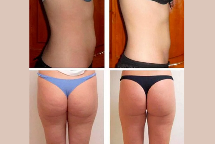 The results of honey massage from cellulite at home