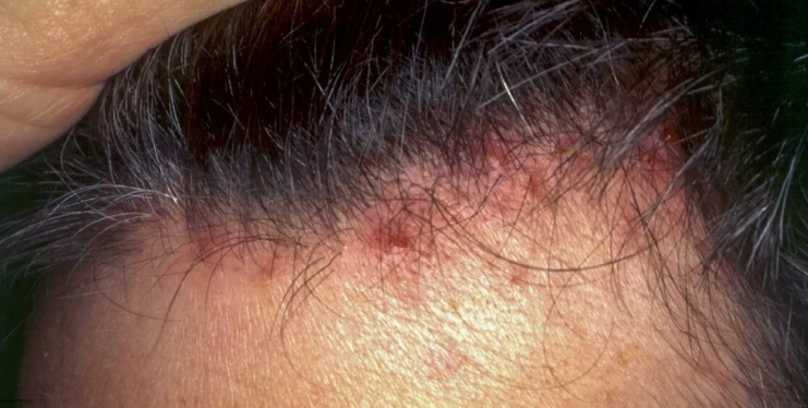 Red spots on the back of the head, under the back of the head