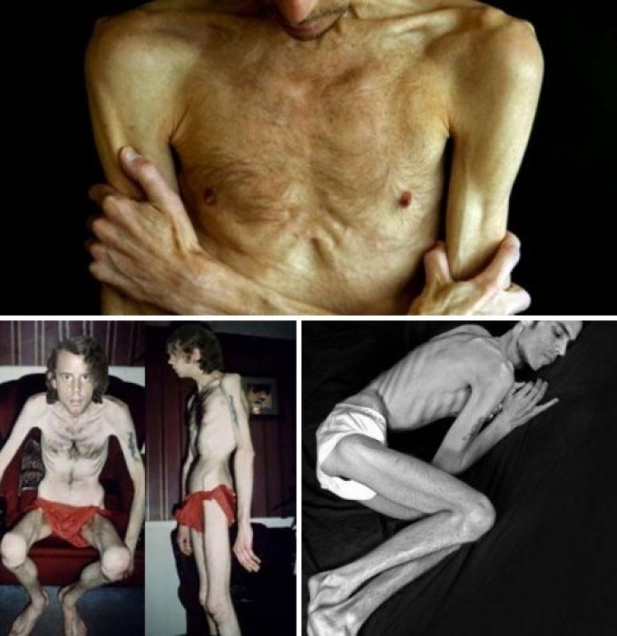 Anorexia in guys can have a sharp current!
