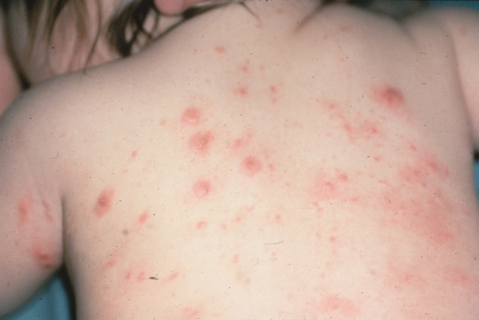 Scabies on the body of the child