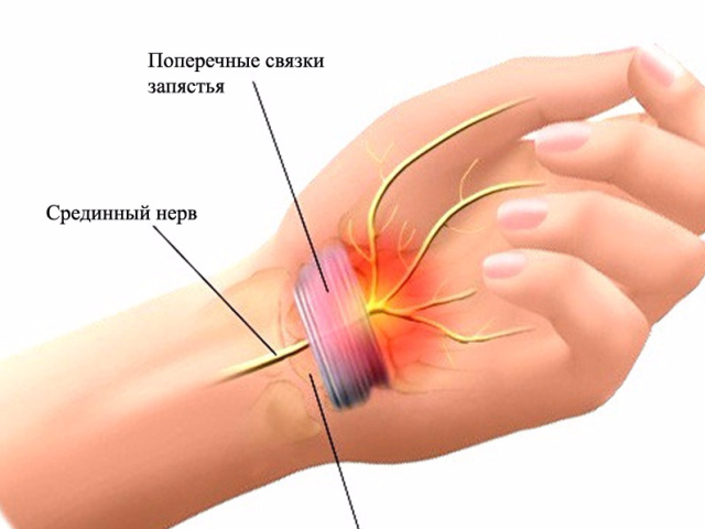 Wer besteht darin, ein Karpalkanal -Syndrom zu entwickeln: Welche Art von Krankheit, Symptomen, Ursachen, Behandlung. In welchen Fällen wird die Operation vorgeschrieben?