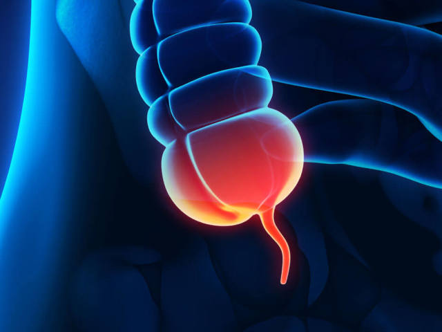 Comment distinguer l'appendicite et son inflammation des autres maladies chez les hommes et les femmes: signes distinctifs. Comment comprendre l'appendicite ou non: symptômes de l'appendicite