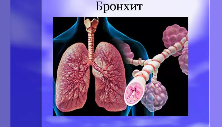 High temperature in an adult and child with bronchitis