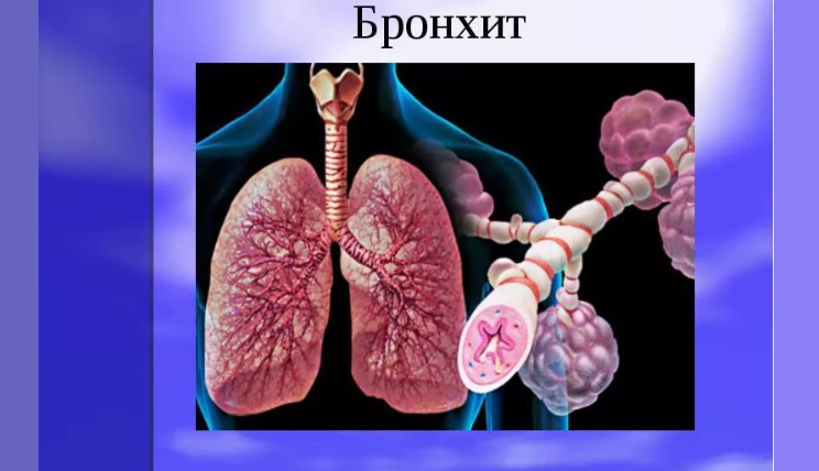 Висока температура у одраслој особи и дете са бронхитисом