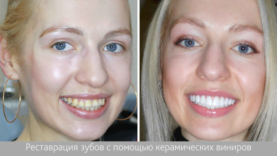 Ugly teeth to the procedure and snow -white teeth after restoration