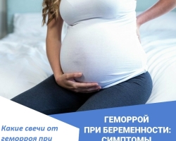 Найкращі свічки, мазі від геморойів під час вагітності є недорогими та ефективними: основні терапевтичні ефекти, огляди. Домашні засоби для лікування гемороїв