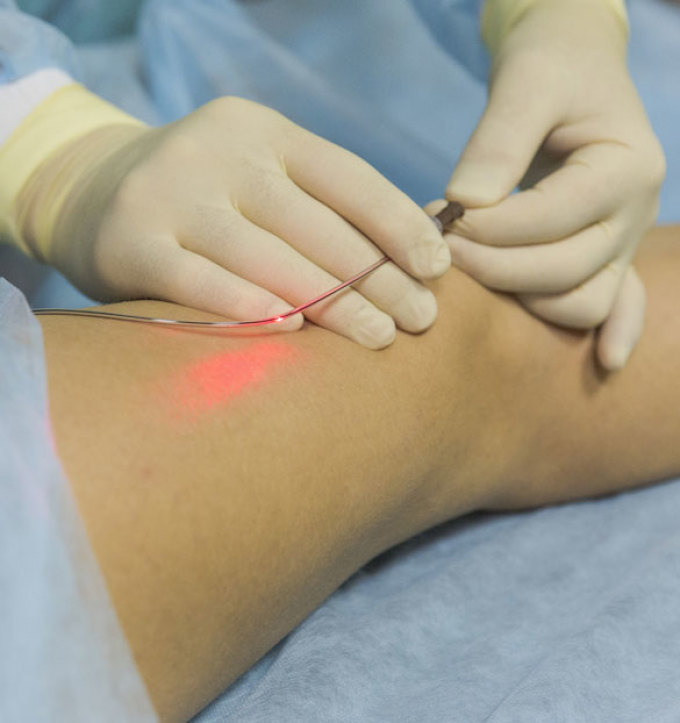 Varicose veins are even treated with a laser, but the device in inept hands can harm