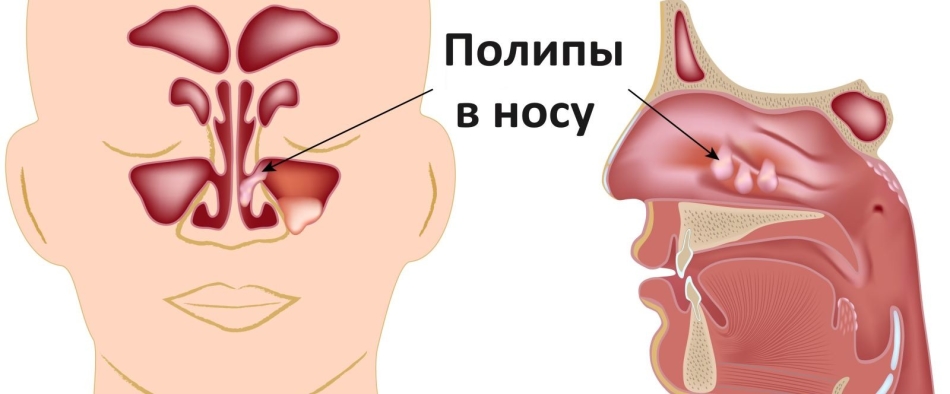 Polypy v nose