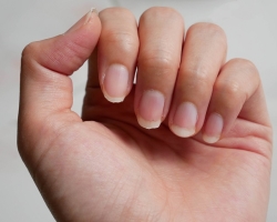 Γιατί τα νύχια βάζουν και σπάσουν: 10 αιτίες εύθραυστων και εύθραυστων καρφιών σε ενήλικες, παιδιά, έγκυες γυναίκες. Γιατί τα νύχια με βερνίκι και σπάσιμο πηκτής Shellac: Αιτίες, κανόνες για τη φροντίδα των εκτεταμένων νυχιών
