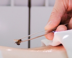 Apitherapy - treatment with bees at home: indications, biologically active points for different diseases, contraindications, side effects, exacerbations. Allowed number of bees bites per day, for the course of treatment and the duration of treatment