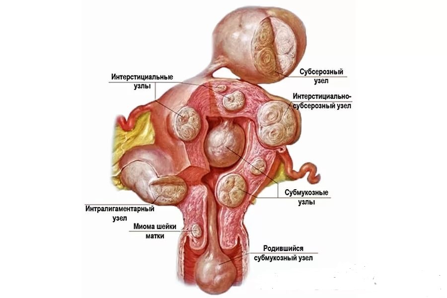 Submukozni maternični fibroidi in nosečnost