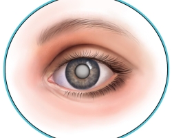 A szem szürkehályog - mi az: okok, tünetek, kezelés