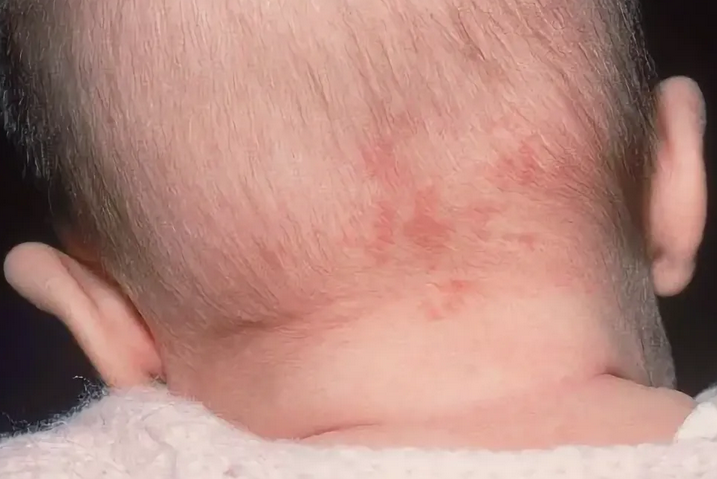 Rdeče lise na zadnji strani glave-2-mesečnega otroka, enoletnega otroka